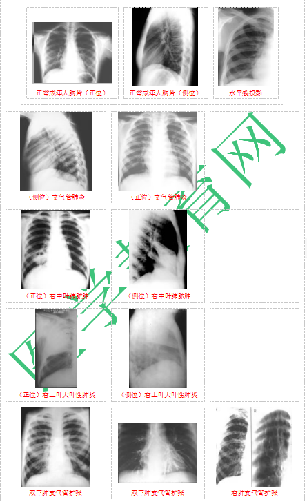 快收藏！臨床助理醫(yī)師實踐技能62個胸片（圖片診斷）